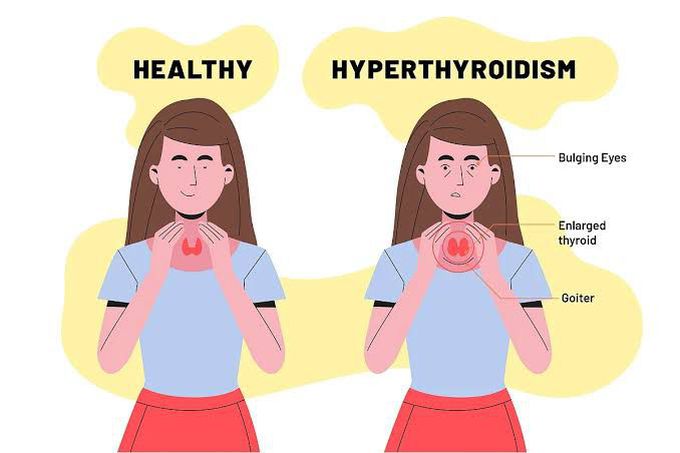 Hyperthyroidism