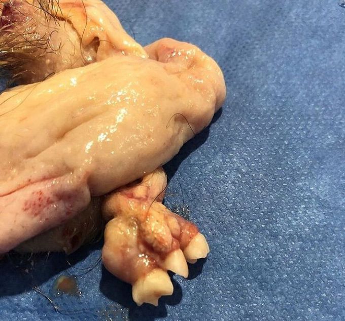 Cystic teratoma