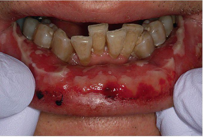 Erythema Multiforme.