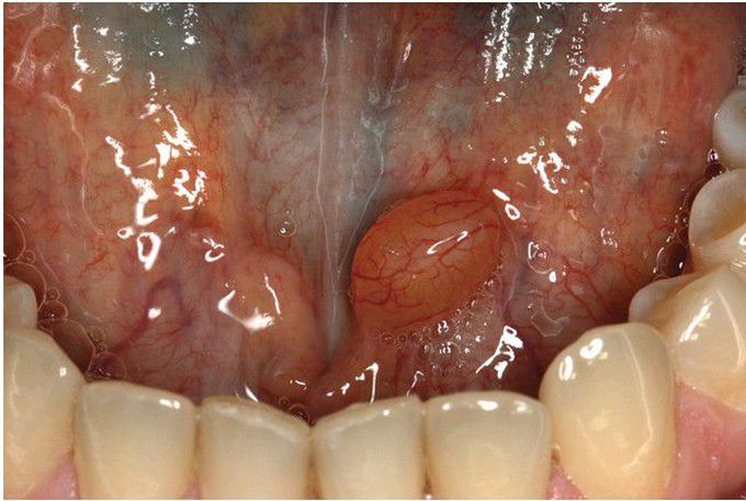 Salivary Duct Cyst.