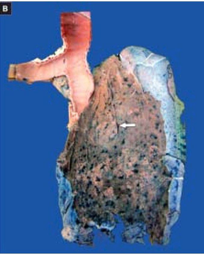 Bronchopneumonia