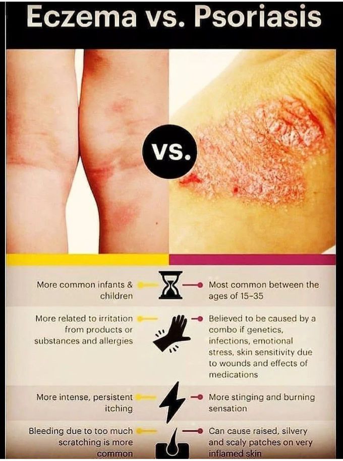 Eczema Vs Psoriasis