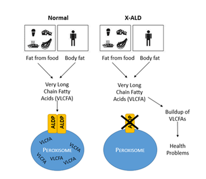 What causes Adrenoleukodystrophy ?