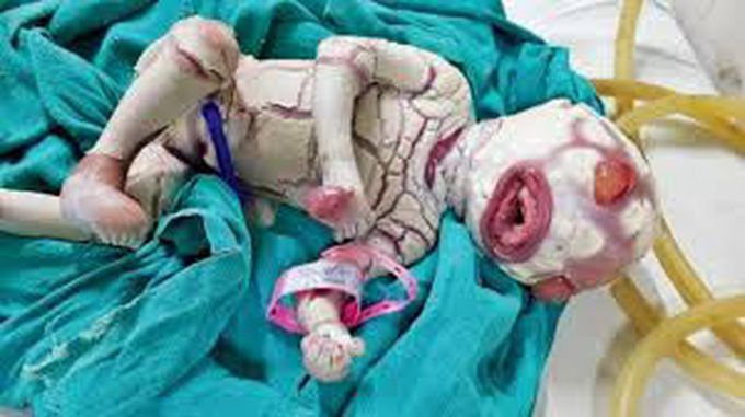 Harlequin syndrome