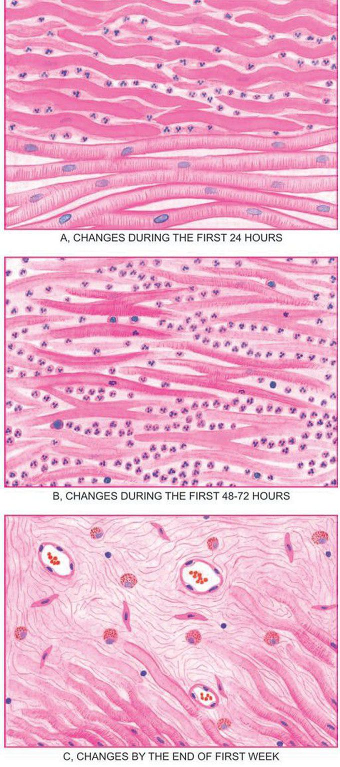 Changes in myocardial infarction.