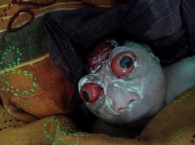 Anencephaly