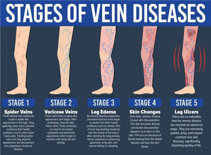 Stages of Vein Diseases