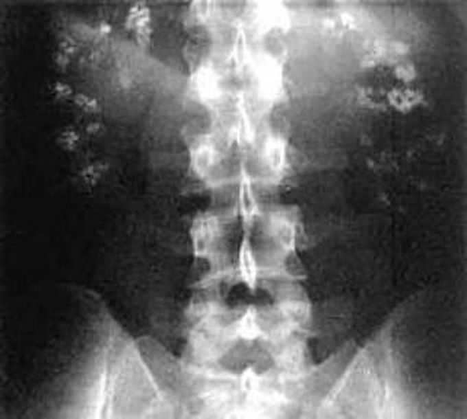 Case of Renal Tubular Acidosis