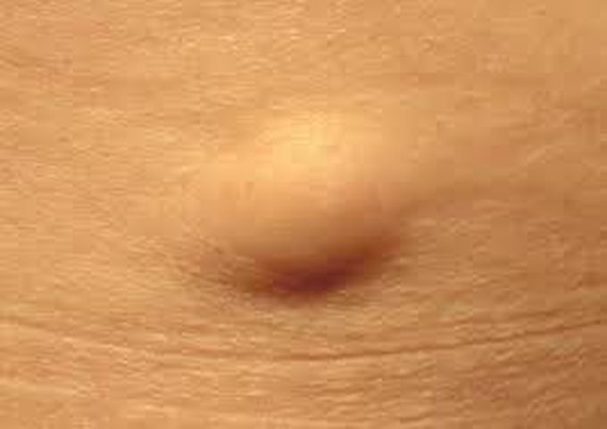 Treatment of lipoma