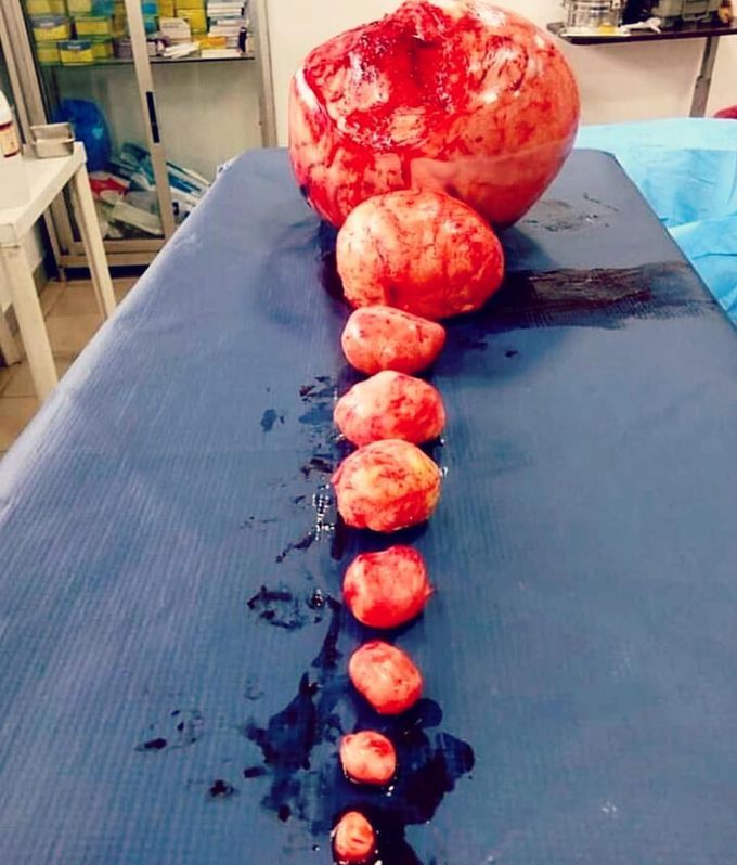 These are uterus masses!