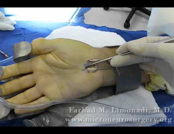 Surgical Treatment of Carpal Tunnel Syndrome