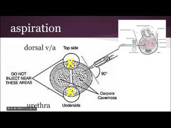 Priapism