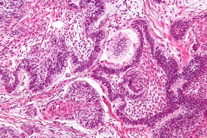 Histology of Ameloblastoma