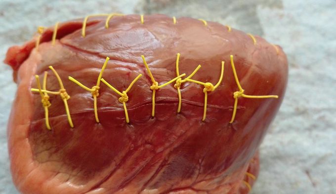 Suture