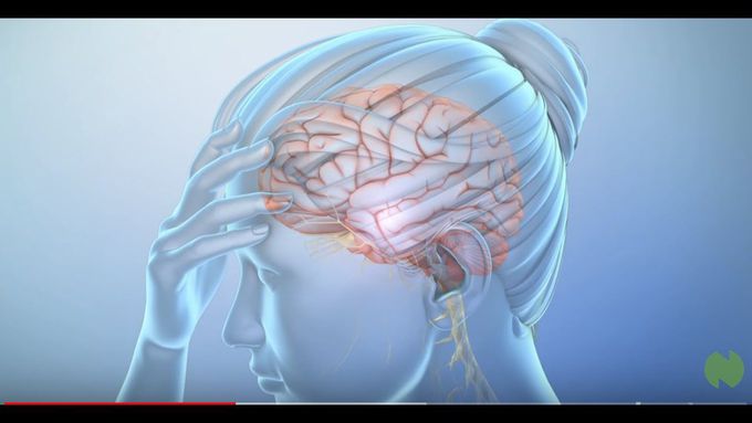 Migraine