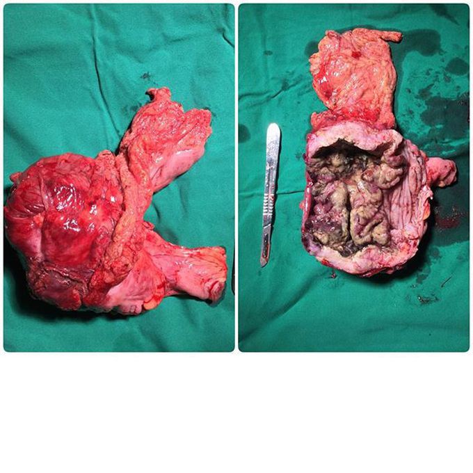 Extended right hemicolectomy due to right colon near the hepatic flexura