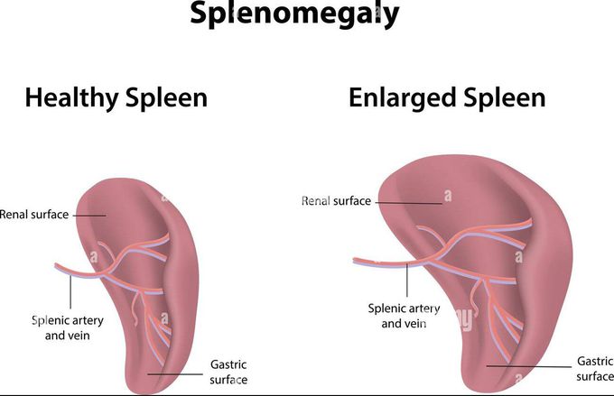 Splenomegaly