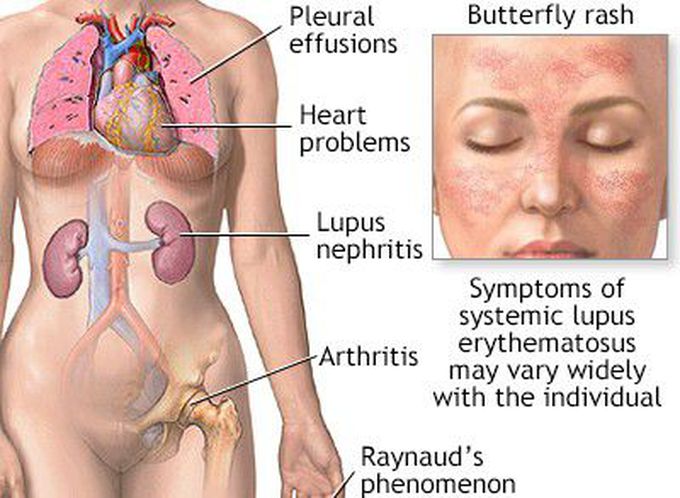 Symptoms of Lupus facial rash