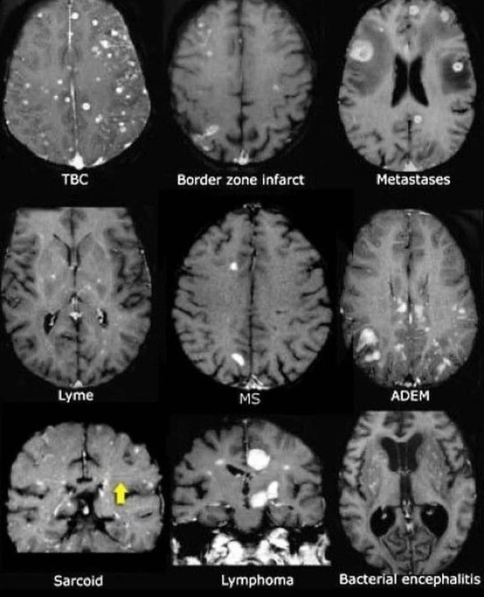 CT Brain