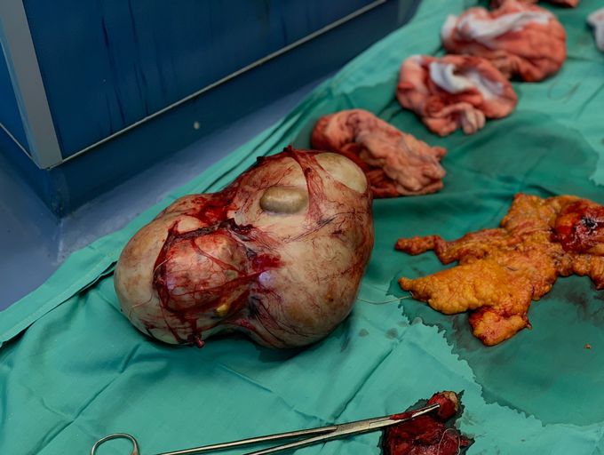 Huge ovarian cyst removed surgically