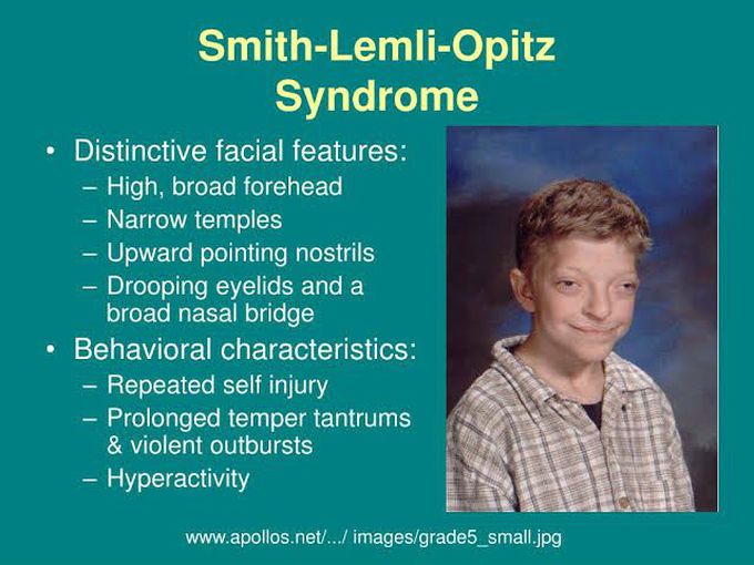 Smith lemli optiz syndrome