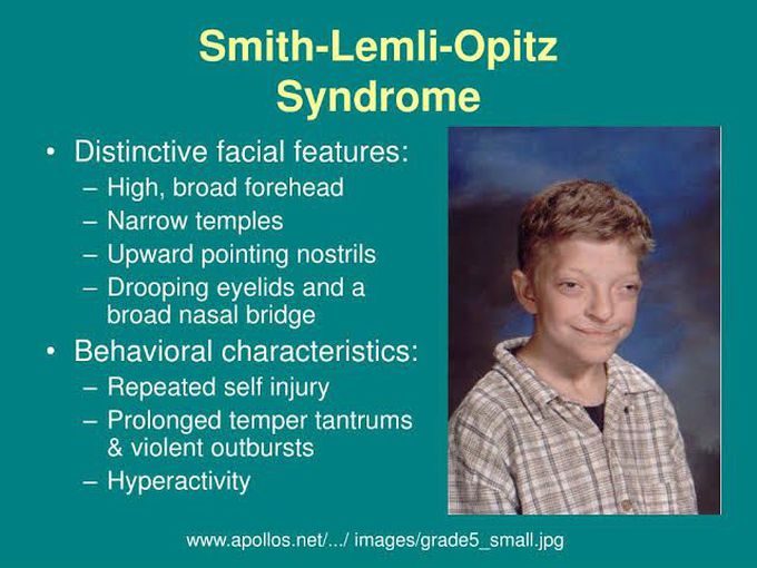 Smith lemli optiz syndrome
