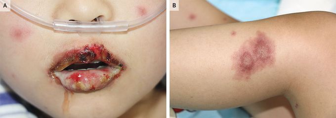 Mycoplasma-Induced Rash and Mucositis