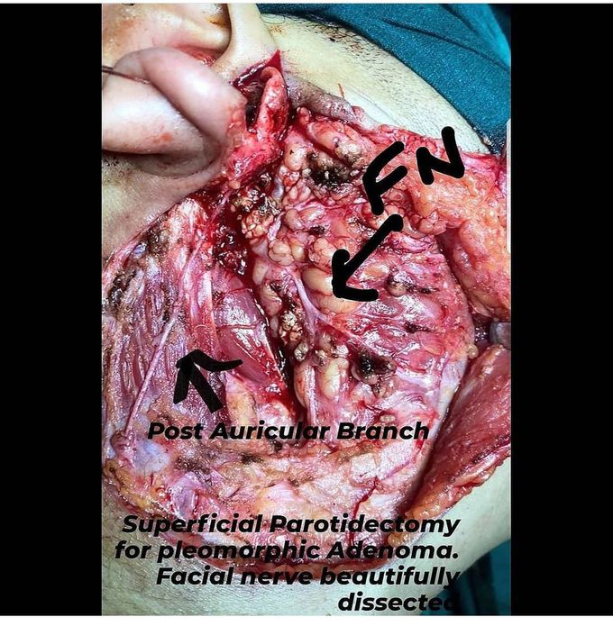 Parotidectomy