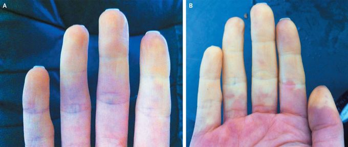 Primary Raynaud's Phenomenon