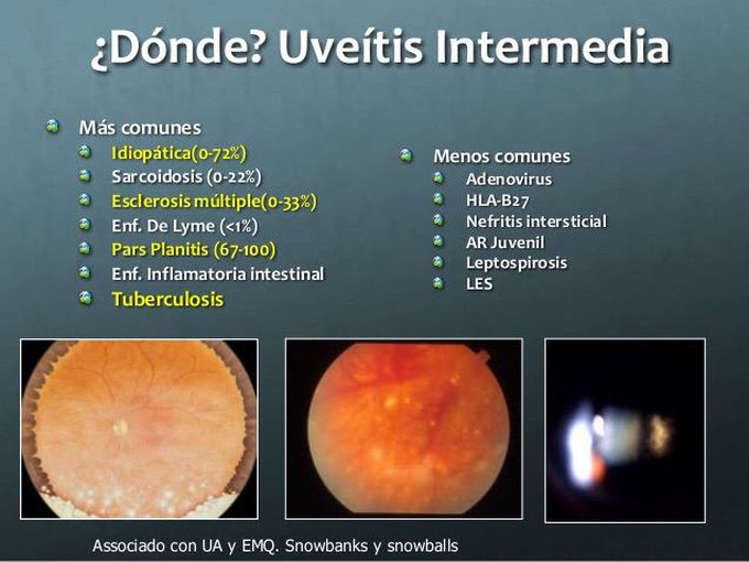 Uveitis intermedia