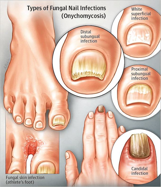 onychomycosis of toenail icd 10