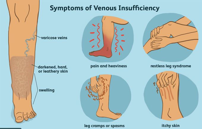 Venous insufficiency