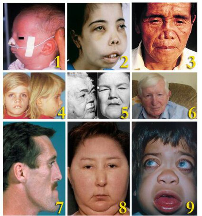 adenoid facies features