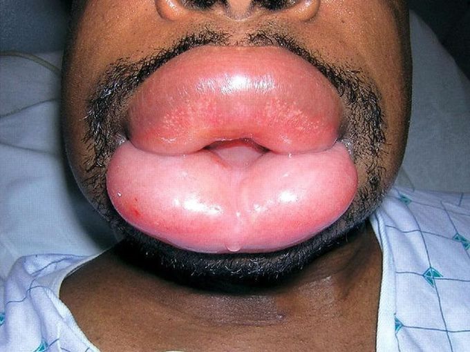 Angioedema of the lips!