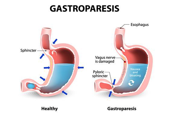 Gastroparesis. - MEDizzy