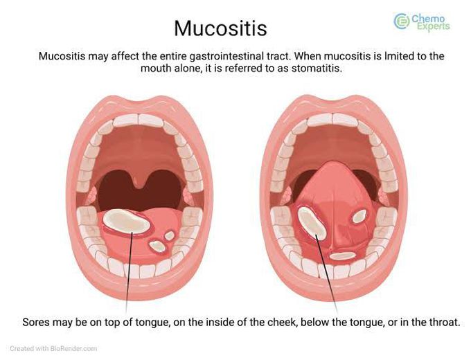 Mucositis