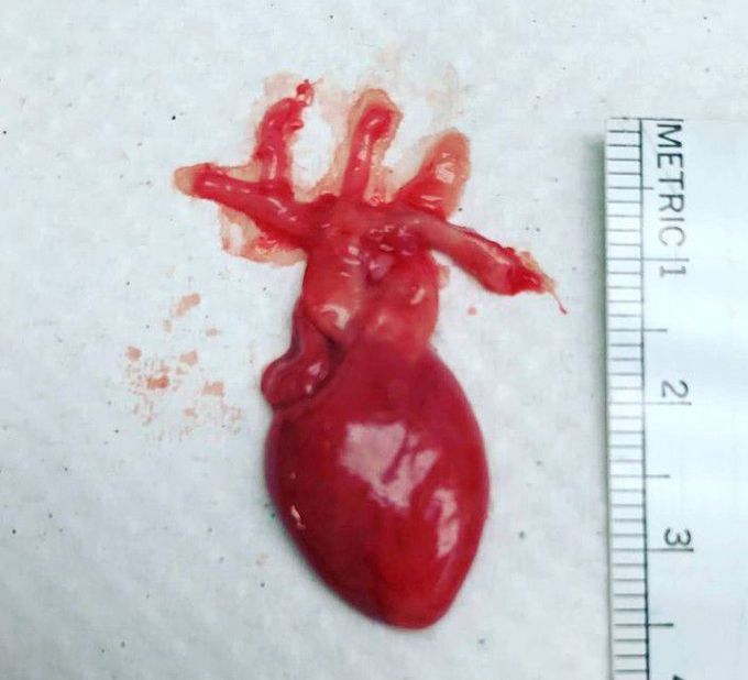 The heart of 21 week fetus