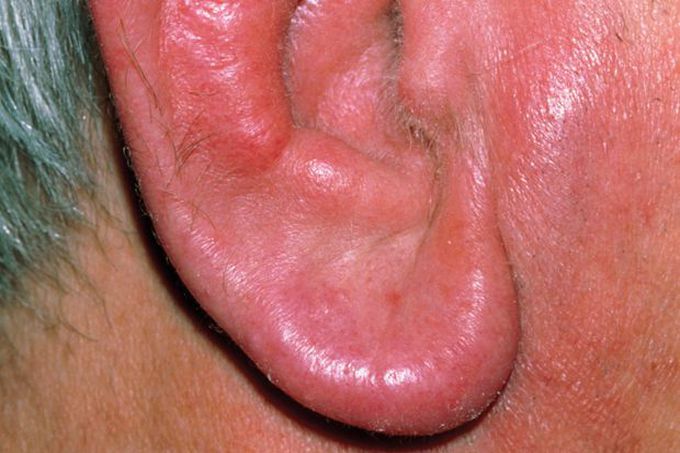 CASE STUDY: Relapsing polychondritis