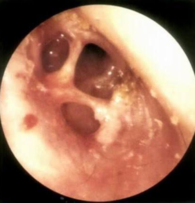 Tuberculosis of the Middle Ear!