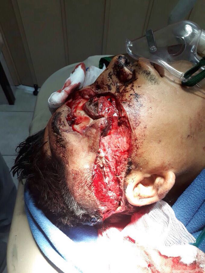 There's a medical term for bikers who don't use their helmets: organ donors. Fortunately, this man didn't die.