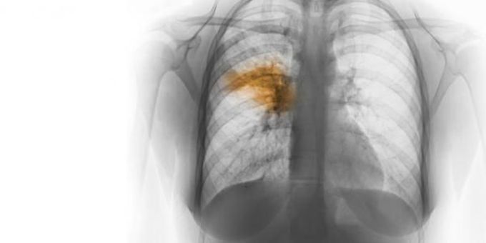 How to Determine Severity of Pneumonia