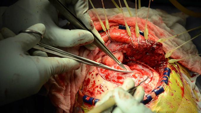 Pterional Craniotomy