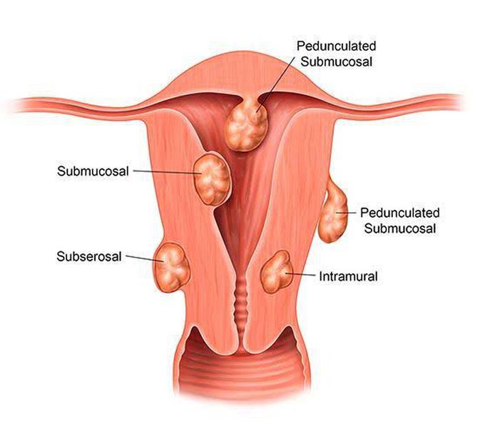 Types of uterine fibroids