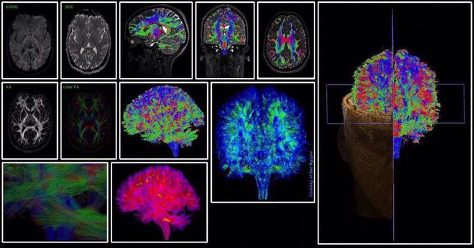 Diffusion Tensor Imaging