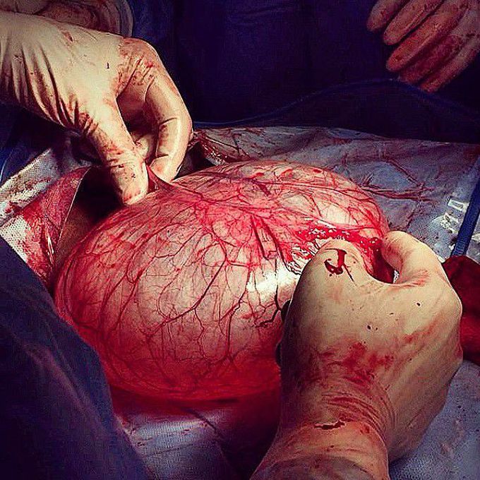 A huge ovarian cyst during pregnancy