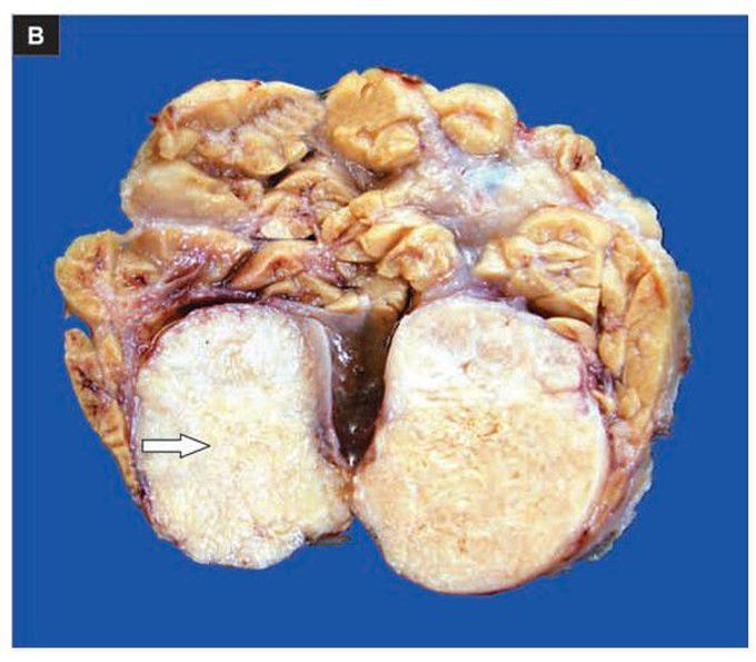 Pleomorphic adenoma (mixed salivary tumour) of the parotid gland.