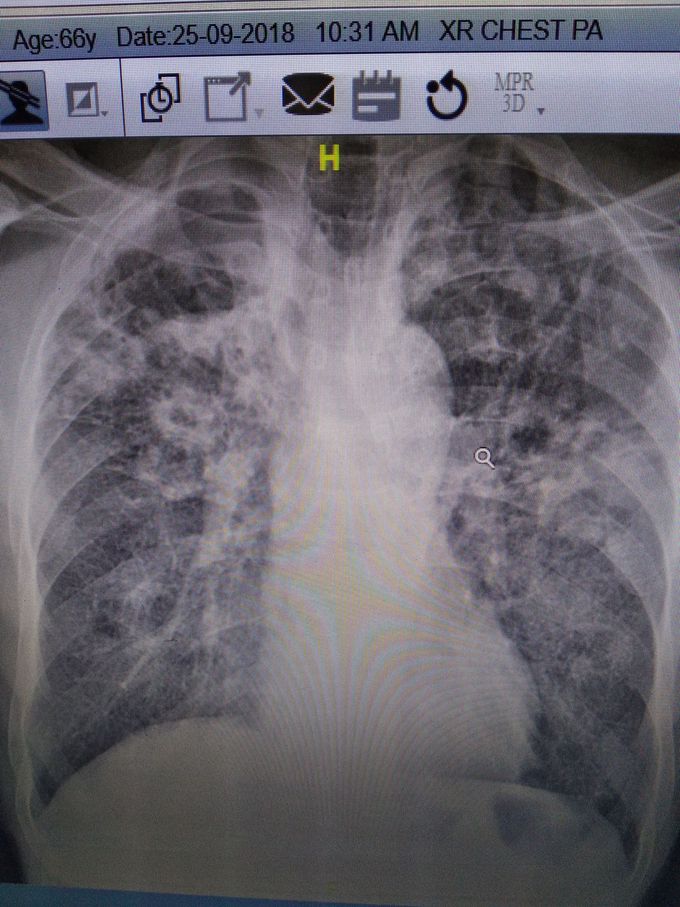 Miliary tb