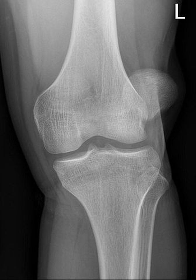 Patellar malalignment