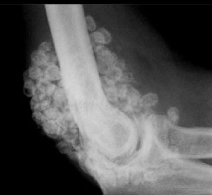 Synovial Osteochondromatosis