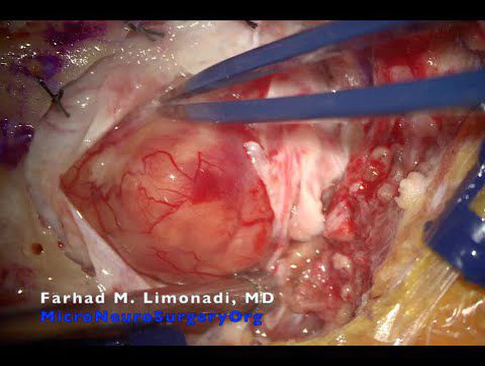 Surgical resection of a metastatic lung cancer to brain.  Brain tumor surgery.